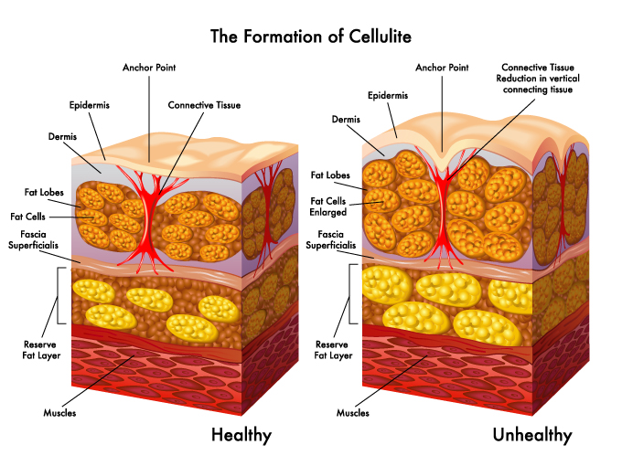 Superficial Layers and Cellulite