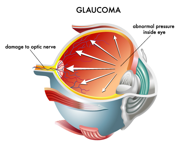 Case Report: Glaucoma