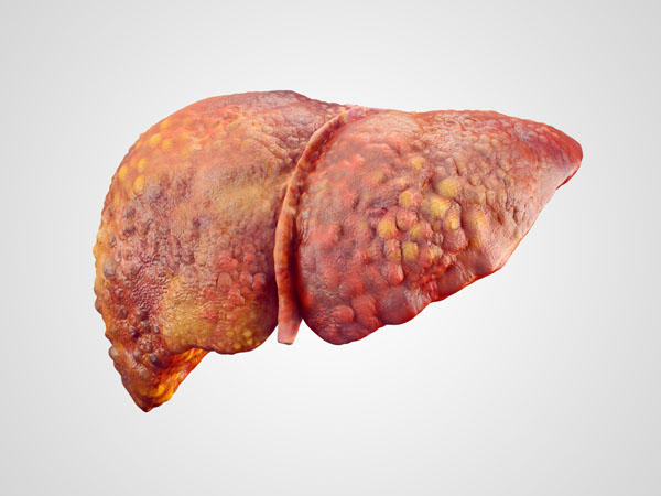 Liver Dysfunction: Biochemical, Fascia, or Fluid